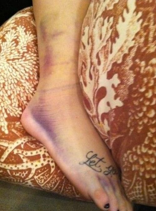 Demi Lovato złamała nogę (FOTO) Demi Lovato złamała nogę (FOTO)