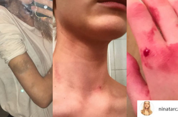 KOSZMAR! Polska modelka POBITA przez chłopaka (Instagram)