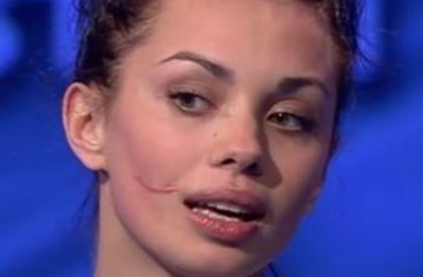 Anna Koryto z Top Model nie ma już blizny (FOTO)