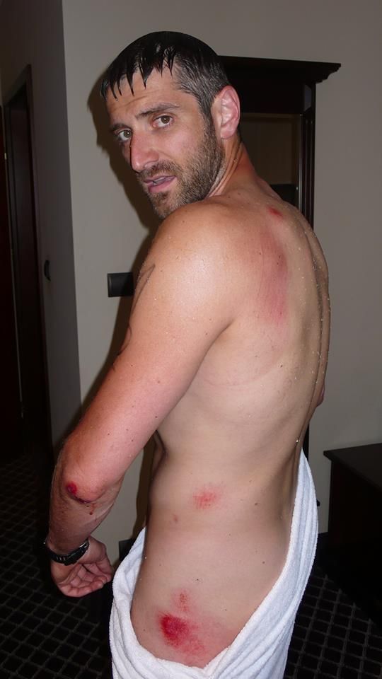 Maciej Dowbor pokazuje swoje poranione ciało (FOTO)