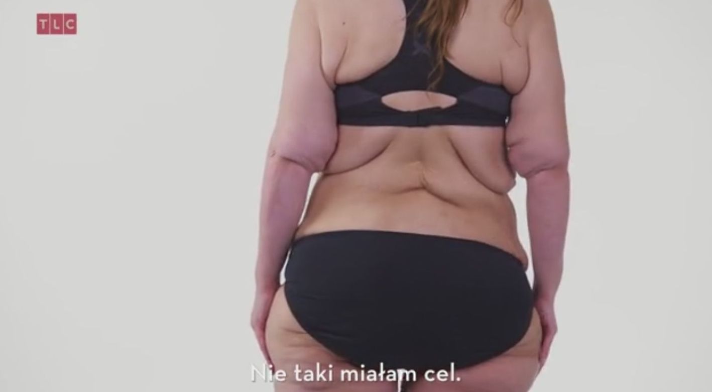 Szpecą ją kilogramy zbędnej skóry (VIDEO)