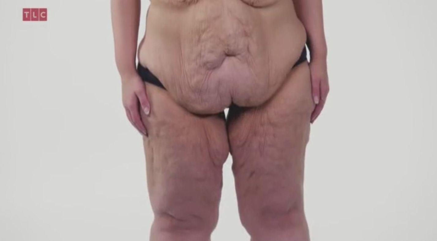 Szpecą ją kilogramy zbędnej skóry (VIDEO) Szpecą ją kilogramy zbędnej skóry (VIDEO)