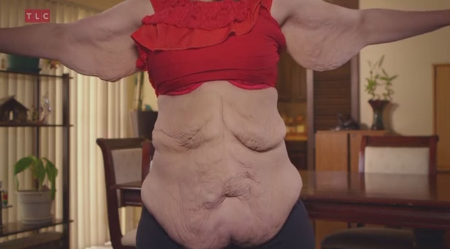 Szpecą ją kilogramy zbędnej skóry (VIDEO) Szpecą ją kilogramy zbędnej skóry (VIDEO)