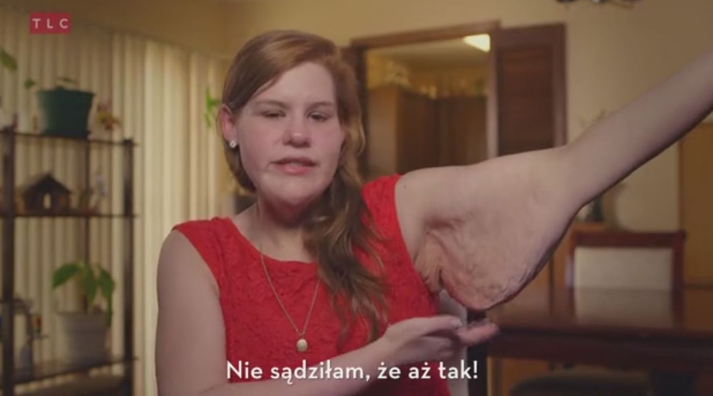 Szpecą ją kilogramy zbędnej skóry (VIDEO) Szpecą ją kilogramy zbędnej skóry (VIDEO)