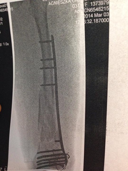Polska Angelina czuje się już lepiej po wypadnięciu z okna?