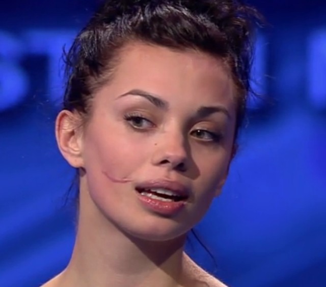 Anna Koryto - dziewczyna z blizną na twarz w Top Model (FOTO