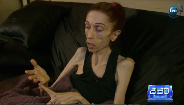 Rachael Farrokh ma 37 lat i waży 20 kilogramów Rachael Farrokh ma 37 lat i waży 20 kilogramów