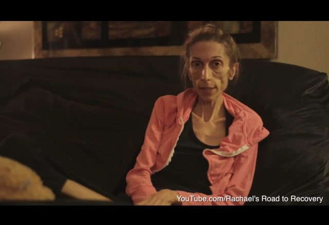 Szok. Ta aktorka chora na anoreksję ważyła niecałe 20 kg