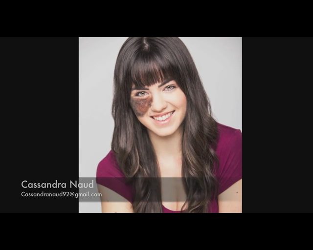 Tancerka ze znamieniem na twarzy nie podda się operacji Tancerka ze znamieniem na twarzy nie podda się operacji