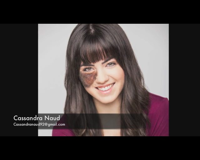 Tancerka ze znamieniem na twarzy nie podda się operacji Tancerka ze znamieniem na twarzy nie podda się operacji