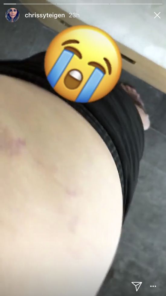 Ciąża nie obeszła się łagodnie z ciałem Chrissy Teigen, wiele kobiet po porodzie Ciąża nie obeszła się łagodnie z ciałem Chrissy Teigen, wiele kobiet po porodzie