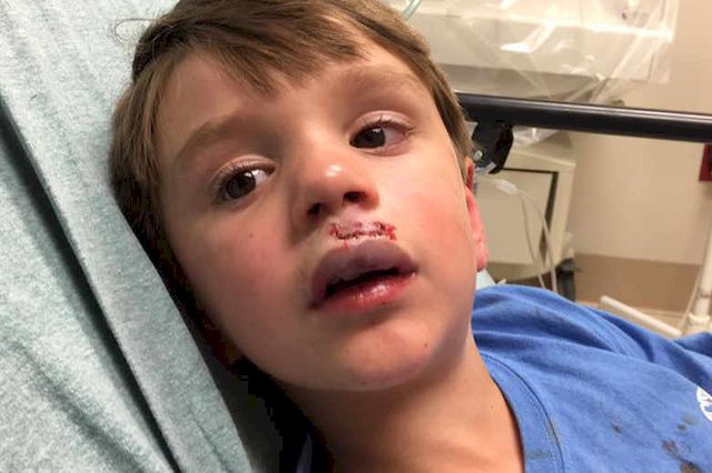 UWAGA! Fidget Spinner EKSLODOWAŁ w twarz dziecka! (ZDJĘCIA)