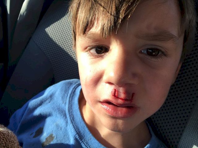 UWAGA! Fidget Spinner EKSLODOWAŁ w twarz dziecka! (ZDJĘCIA)