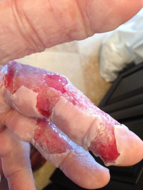 Hulk Hogan pochwalił się poparzoną ręką (FOTO)