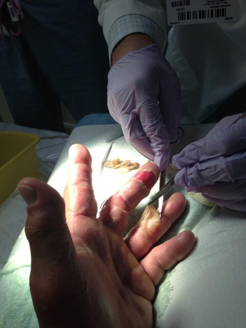 Hulk Hogan pochwalił się poparzoną ręką (FOTO)