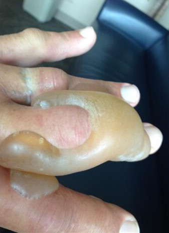 Hulk Hogan pochwalił się poparzoną ręką (FOTO)