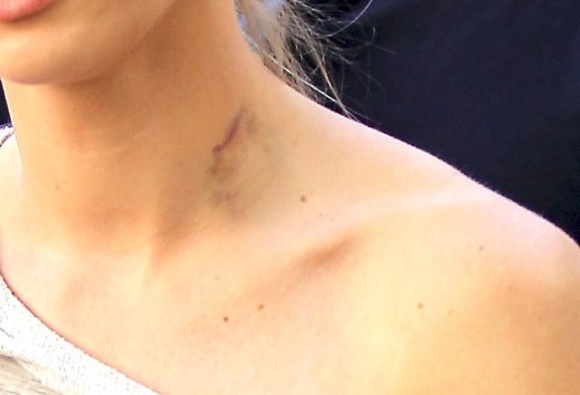 Polska modelka z siniakiem na szyi (FOTO)