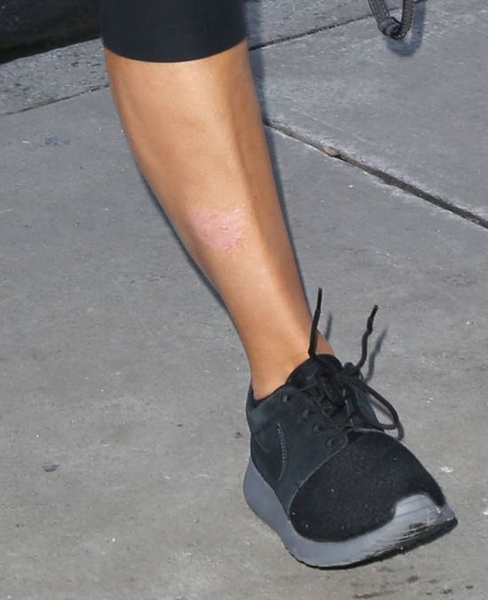 Łuszczyca spędza sen z powiek Kim Kardashian (FOTO)