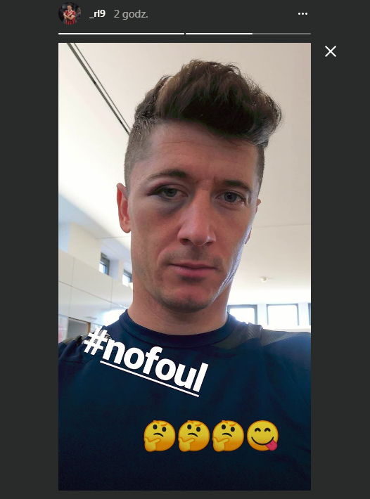 Lewandowski ma PODBITE oko! Co się stało? Lewandowski ma PODBITE oko! Co się stało?