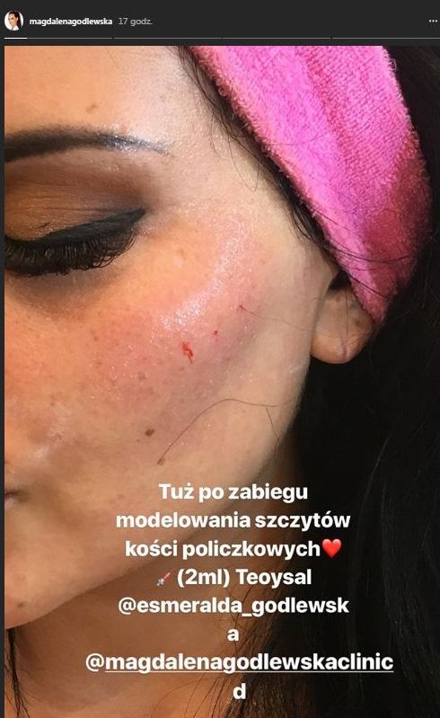 Esmeralda Godlewska pokazuje, jak sobie ROBI policzki Esmeralda Godlewska pokazuje, jak sobie ROBI policzki