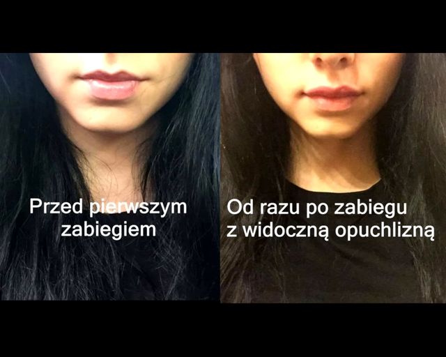 Mamiko pokazała, jak powiększała usta kwasem hialuronowym (VIDEO)