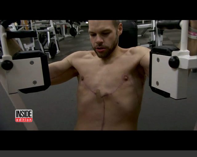 Schudł 190 kg, lekarze wycięli mu 15 kilo wiszącej skóry