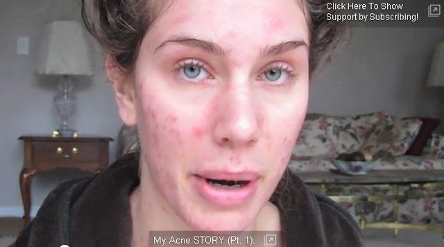 Miała straszny trądzik, dziś jest modelką [VIDEO]