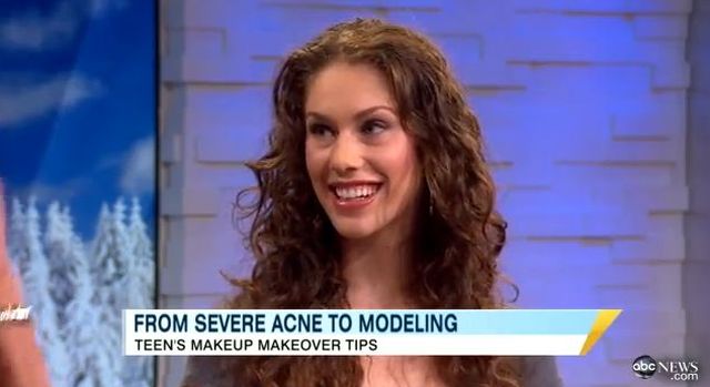 Miała straszny trądzik, dziś jest modelką [VIDEO]