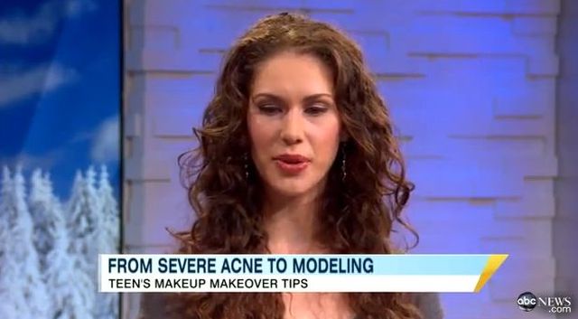 Miała straszny trądzik, dziś jest modelką [VIDEO]
