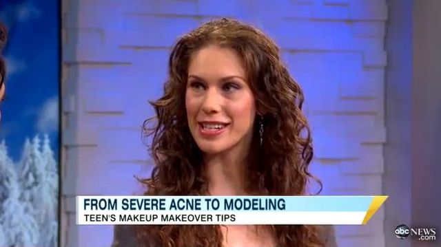 Miała straszny trądzik, dziś jest modelką [VIDEO]