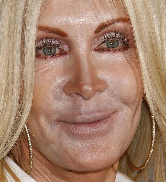 Joan Van Ark powinna zwolnić chirurga i makijażystę