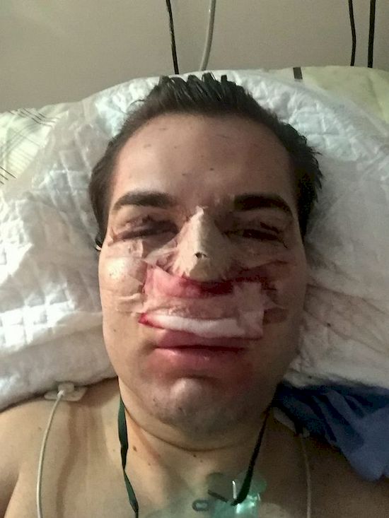 Żywemu Kenowi ODPADA NOS! Rodrigo Alves przesadził z operacjami