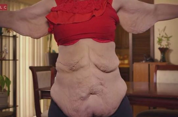 Szpecą ją kilogramy zbędnej skóry (VIDEO)