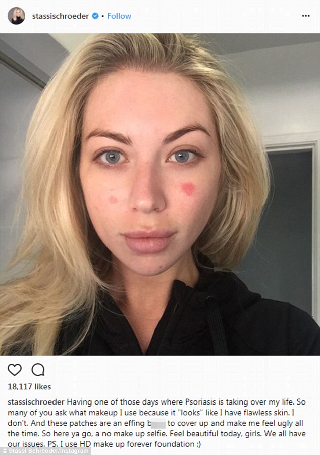 Stassi Schroeder pokazała twarz bez makijażu, z łuszczycą (ZDJĘCIA)