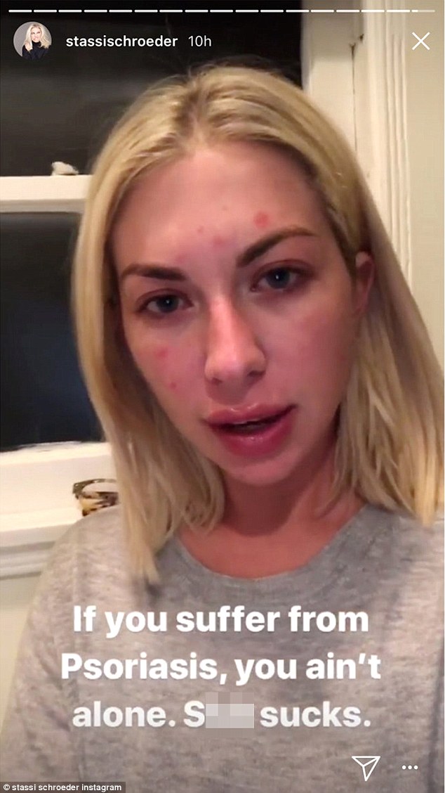 Stassi Schroeder pokazała twarz bez makijażu, z łuszczycą (ZDJĘCIA)