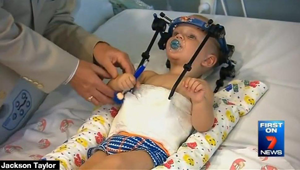 To CUD! Dziecko, któremu głowa oderwała się od karku CHODZI! To CUD! Dziecko, któremu głowa oderwała się od karku CHODZI!