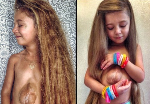 Ta 6-letnia dziewczynka ma... serce poza klatką piersiową!