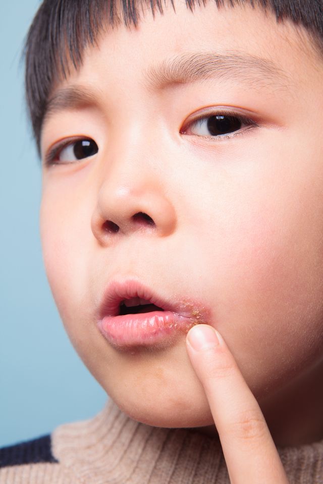 Skąd się biorą zajady na ustach i jak je szybko wyleczyć?