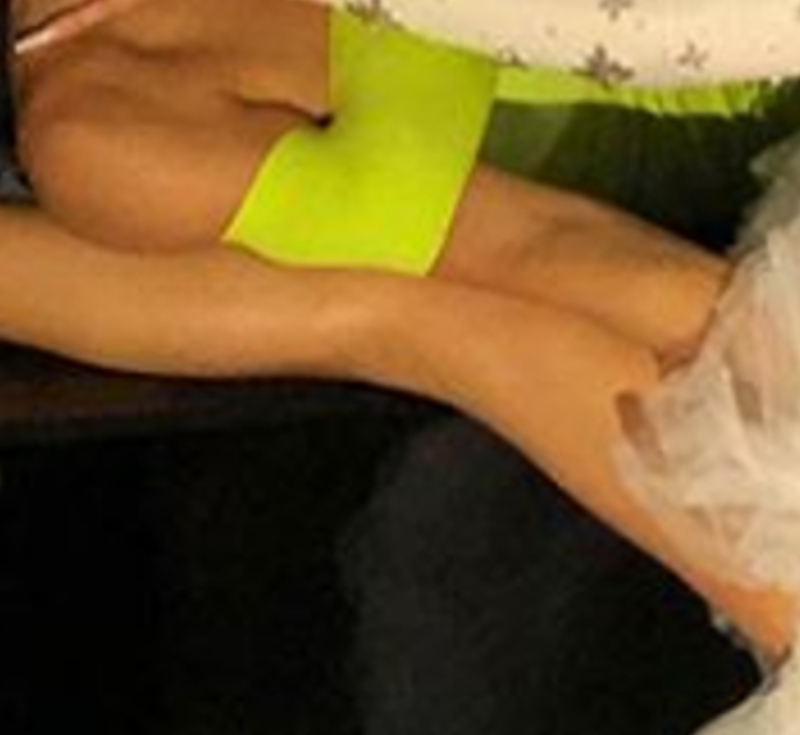 Chudziutka noga Khloe przeraża. Co się z nią stało?