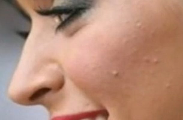 Katy Perry: specyfiki przeciw trądzikowi nie działają