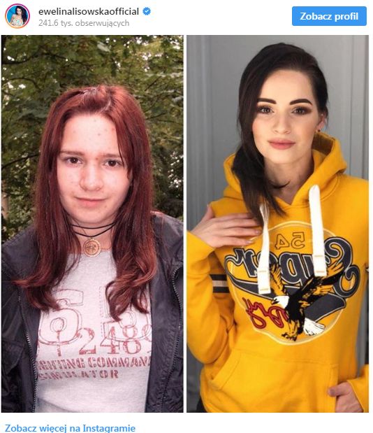 Ewelina Lisowska organizuje LIVE na temat swojego NOSA - miała operację?