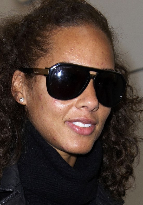 Te gwiazdy borykają się z trądzikiem (FOTO)