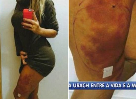 Andressa Urach w stanie krytycznym po operacji plastycznej!