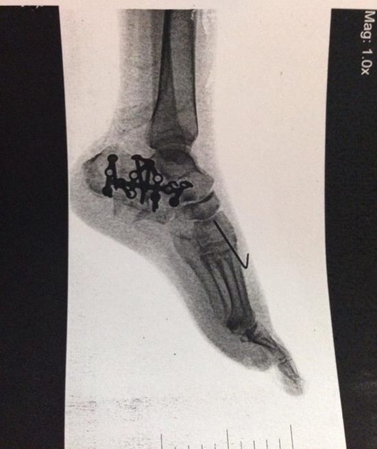 Polska Angelina czuje się już lepiej po wypadnięciu z okna? Polska Angelina czuje się już lepiej po wypadnięciu z okna?