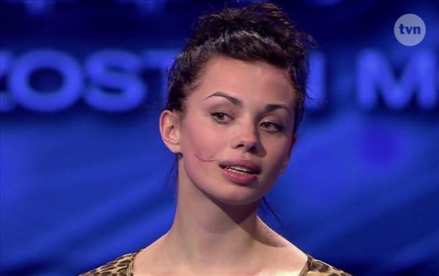 Anna Koryto opowiada o usunięciu blizny (VIDEO)