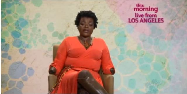 Chciała powiększyć pośladki, została kaleką (FOTO+VIDEO) Chciała powiększyć pośladki, została kaleką (FOTO+VIDEO)