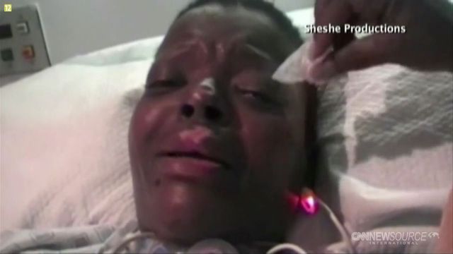 Chciała powiększyć pośladki, została kaleką (FOTO+VIDEO) Chciała powiększyć pośladki, została kaleką (FOTO+VIDEO)