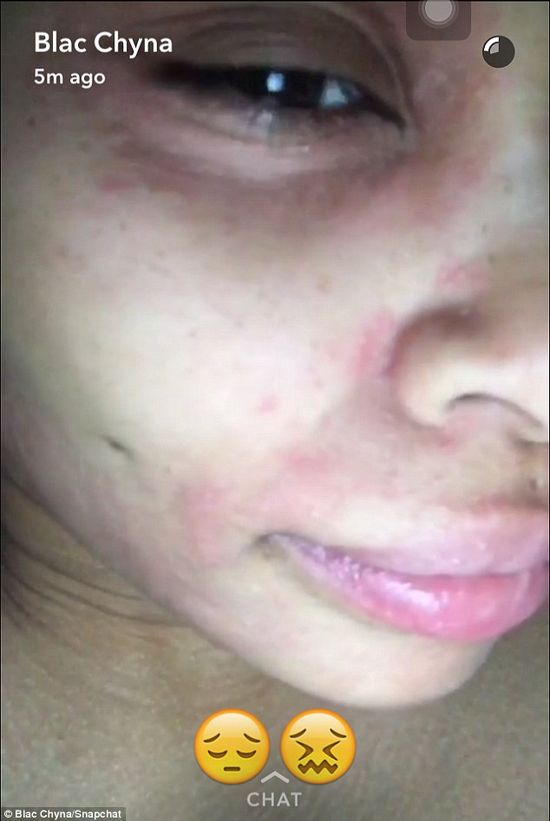 Blac Chyna opublikowała zdjęcie po nieudanym zabiegu kosmetycznym (FOTO)