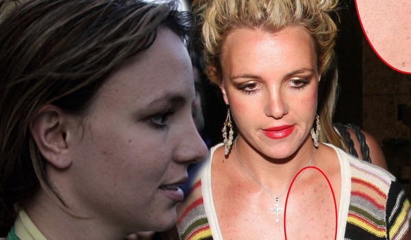 Te gwiazdy borykają się z trądzikiem (FOTO)