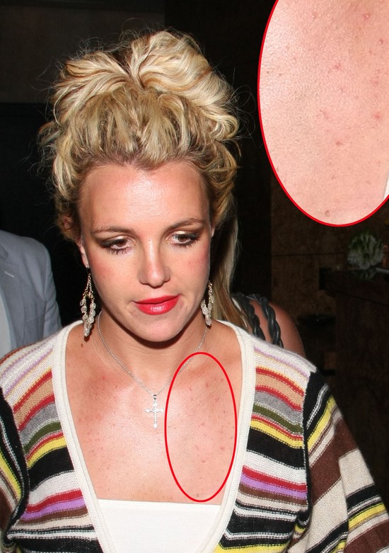 Te gwiazdy borykają się z trądzikiem (FOTO)